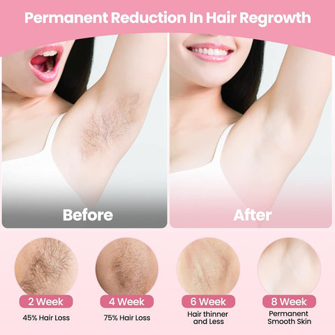 Hair Removal Device, IPL Hair Removal, Laser Hair Removal for Women and Men 999,999 Flashes Permanent for Facial Facial Legs Arms Bikini Line Whole Body Use at-Home(Model: TFDA06S-A)